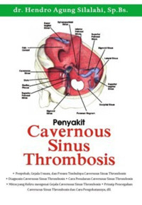 Image of Penyakit Cavernous Sinus Thrombosis